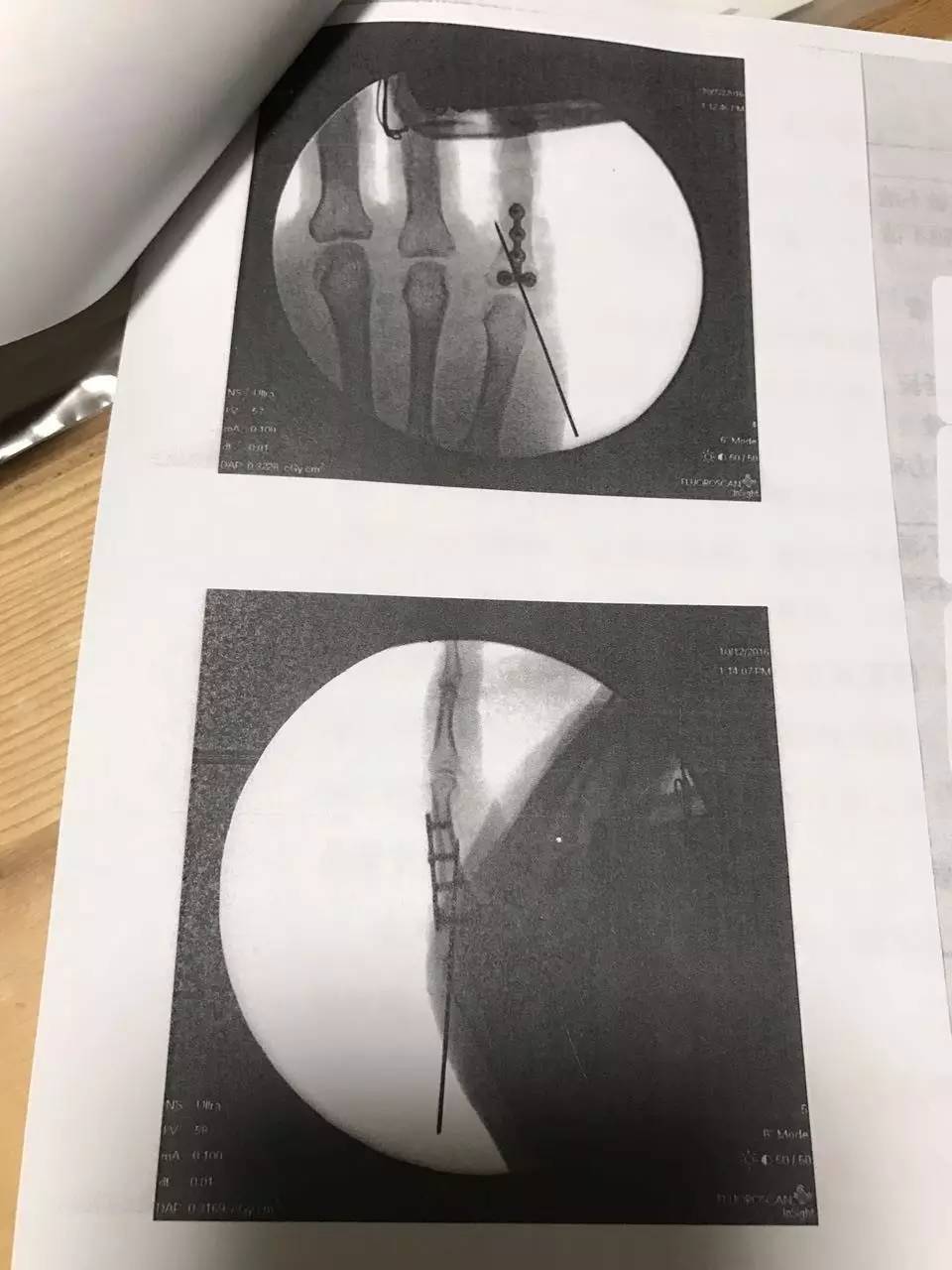 传递正能量：即使受了伤，也无法阻挡他们继续打铁的脚步