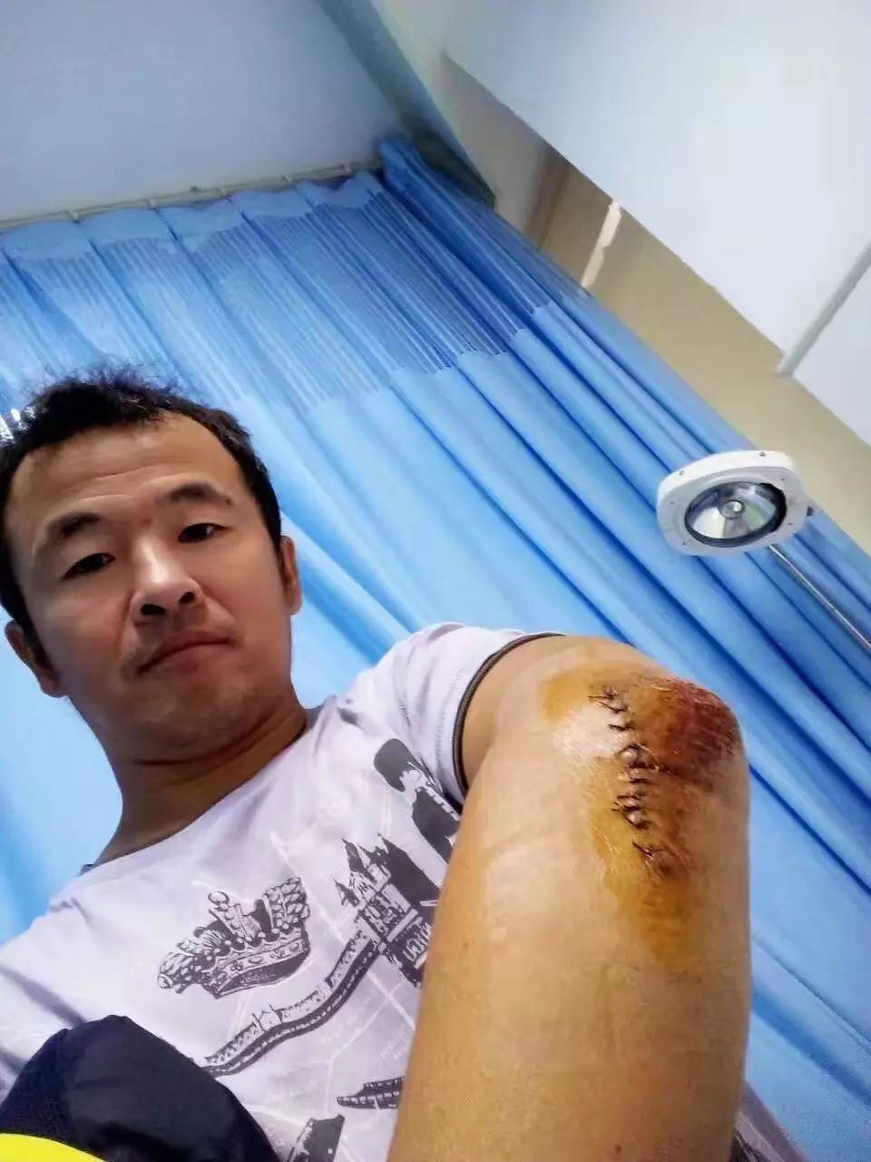 传递正能量：即使受了伤，也无法阻挡他们继续打铁的脚步