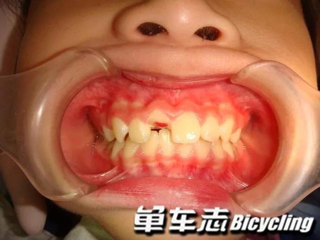 骑车摔伤牙齿怎么办？