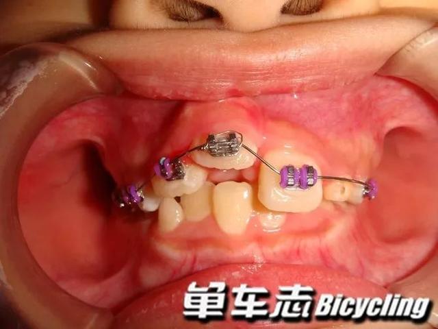 骑车摔伤牙齿怎么办？