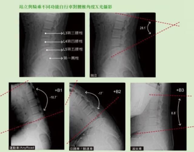骑自行车可减少腰椎神经压迫