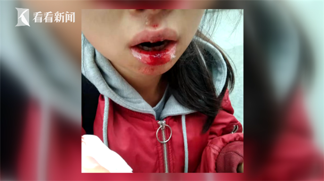 女子骑车被磕掉牙 OfO称“我们没有赔偿服务”
